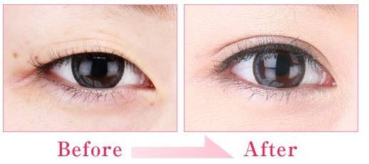 新鄉(xiāng)玻尿酸去除黑眼圈醫(yī)生