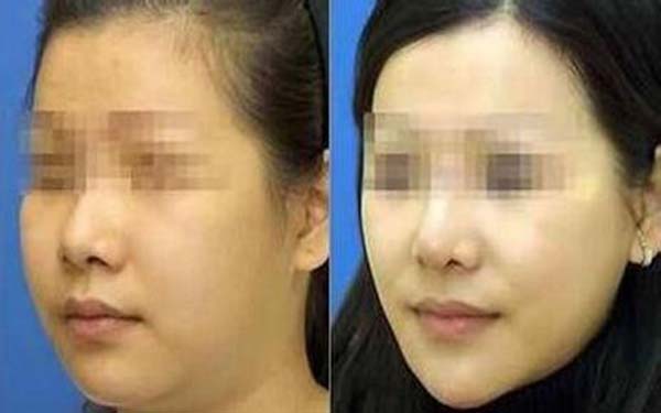 鄭州地區(qū)綜合排名靠前的雙眼皮醫(yī)院Top 5！當(dāng)?shù)丶夹g(shù)精湛且備受歡迎