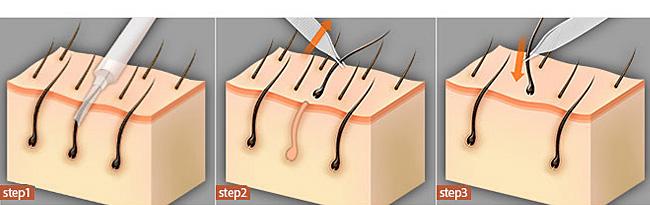 福州祛痣醫(yī)院推薦！快速了解前八家信譽口碑醫(yī)院