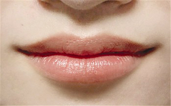 廈門(mén)肉毒素印第安紋注射醫(yī)生