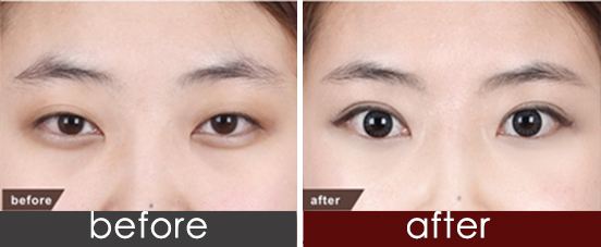 烏魯木齊肥厚鼻翼醫(yī)生