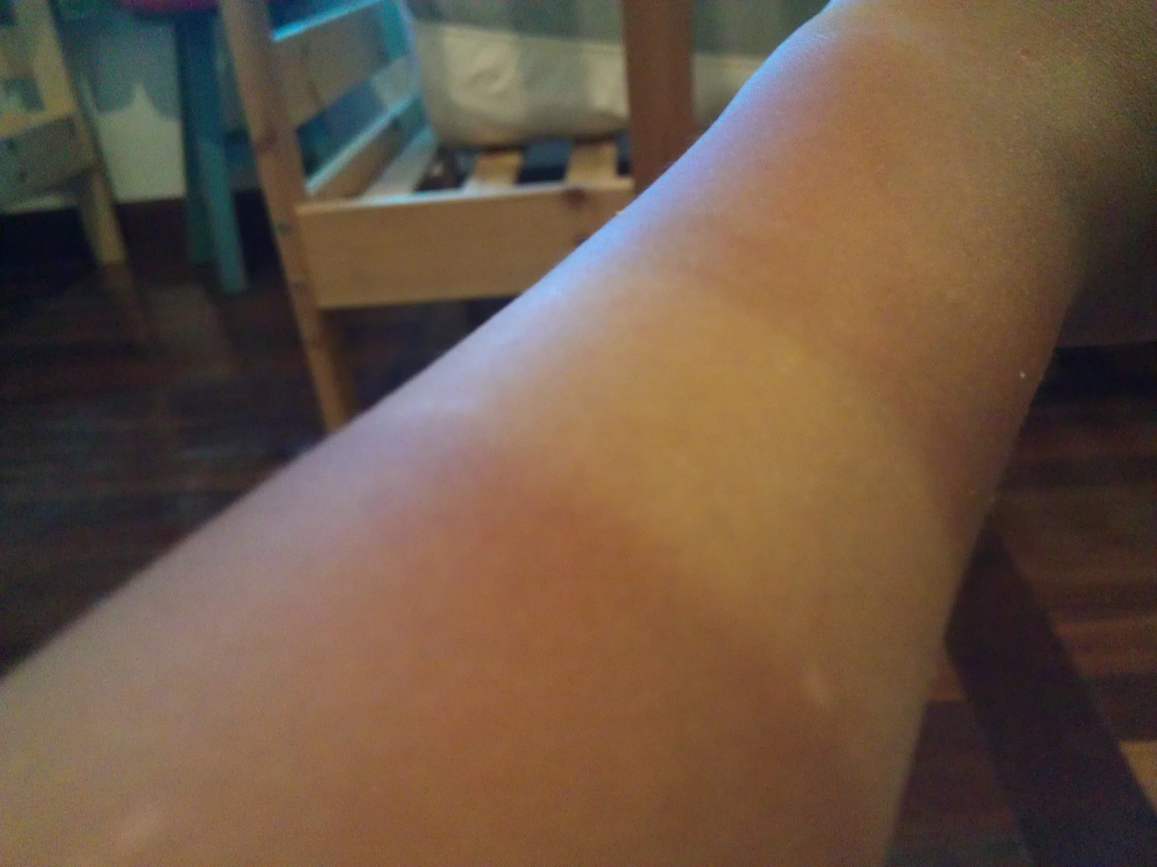 蚌埠點(diǎn)陣祛痘印醫(yī)生