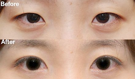 深圳黃金微針去除口周紋醫(yī)生