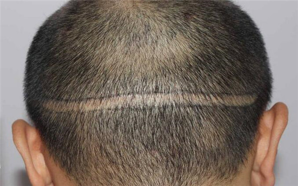 2023年天津黑眼圈治療醫(yī)院推薦，看看那位醫(yī)生的技術(shù)厲害