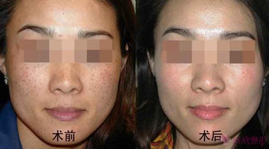 揭陽自體脂肪填充豐唇醫(yī)生