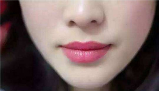 廈門深皺紋修復(fù)醫(yī)生