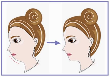 泉州眼周紋凹陷填充哪家醫(yī)院值得選擇？2023年泉州眼周紋凹陷填充美容醫(yī)院強(qiáng)榜揭曉！