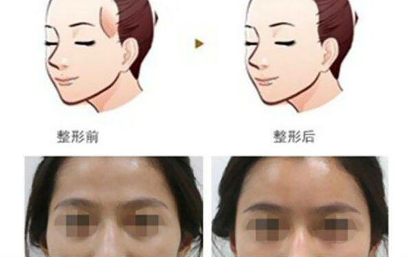 洛陽哪家醫(yī)院做木偶紋效果好？2023榜單出爐，洛陽物理去木偶紋top10佳選露面！