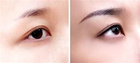 2023年北京開眼角整形醫(yī)院排行榜TOP10公布！哪家醫(yī)院口碑比較好？