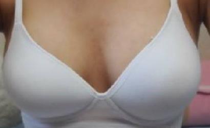 成都骨膠原填充下巴醫(yī)生