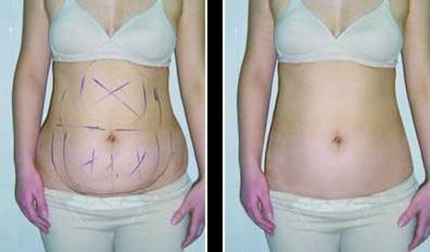 佛山非常受歡迎的雙眼皮納米手術(shù)醫(yī)院排行榜，詳細(xì)揭秘2023年前10名醫(yī)療整形機(jī)構(gòu)！