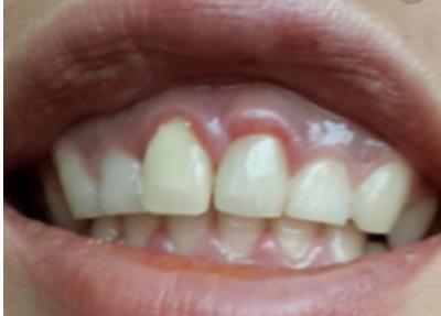 黃石哪家醫(yī)院能填充太陽(yáng)穴假體？2023黃石太陽(yáng)穴美容前十有哪些好選擇！