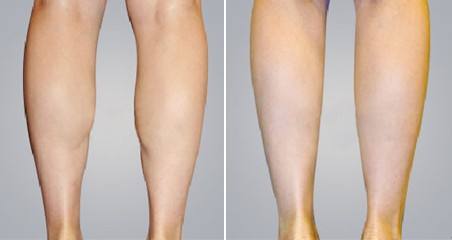 寶雞祛除眉間紋醫(yī)生