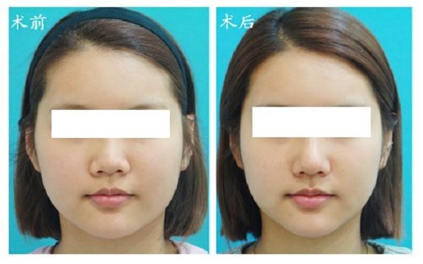 南陽(yáng)哪家醫(yī)院注射鼻基底效果好？2023南陽(yáng)玻尿酸注射鼻基底排行榜出爐！全城皆贊的十大醫(yī)院盤點(diǎn)！