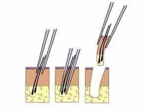 2023鄭州哪家整形醫(yī)院口碑好？眼角紋去除效果！