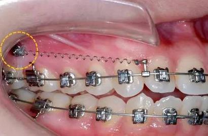 杭州哪家醫(yī)院做玻尿酸填充淚溝好？2023年排行榜公布！