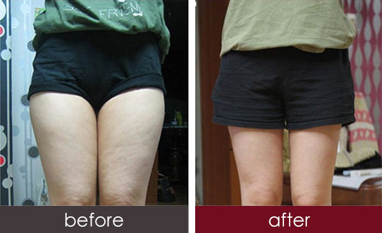 遵義激光祛疤術(shù)醫(yī)生