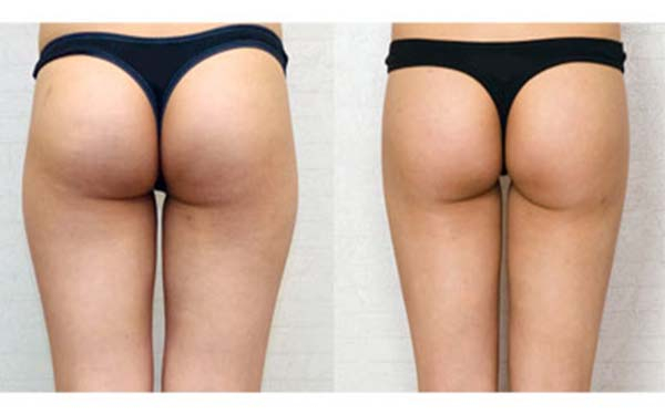 北京治療面部皺紋效果好的自體脂肪注射醫(yī)院哪家靠前？2023年北京自體脂肪注射面部皺紋醫(yī)療醫(yī)院TOP10排名榜