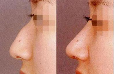 江陰溶脂針瘦背哪家整形美容醫(yī)院更受推薦？2023年江陰比較好的溶脂針瘦背醫(yī)院排行榜揭曉！前10強(qiáng)名單一覽！