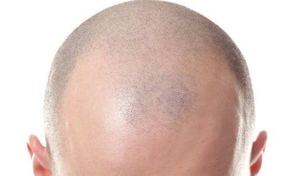 【2023】武漢法令紋拉皮手術(shù)排行榜公開(kāi)推薦，十大整形醫(yī)院全程揭秘！