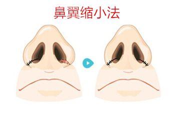 2023成都極具聲望的木偶紋填充玻尿酸醫(yī)療中心排行榜！驚喜揭曉