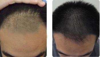 鎮(zhèn)江哪家醫(yī)院效果好？2023年玻尿酸填充額頭美容醫(yī)院排名全新預(yù)測！