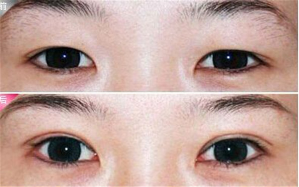 杭州哪家整形醫(yī)院效果好，專業(yè)解決祛痘坑痘印問題，2023很受歡迎的前十家！