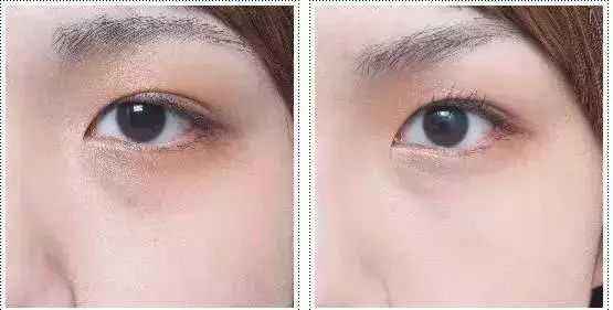 2023德州眼底紋玻尿酸注射整形美院排行榜，你知道嗎？