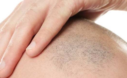 2023三亞微晶磨削點(diǎn)痣醫(yī)療美容醫(yī)院推薦，求穩(wěn)定效果好的！