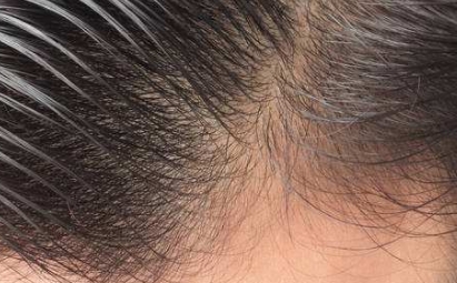 2023年牡丹江比較推崇的玻尿酸填充隆胸?？漆t(yī)院排行榜來啦！