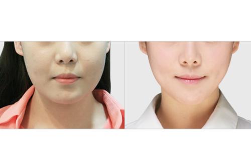 2023杭州祛生長紋醫(yī)院排行榜公布！這些整形專家經(jīng)驗豐富的醫(yī)院排名前十！