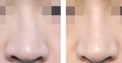 湖南哪家醫(yī)院比較好做光乳化手術(shù)祛眼袋？湖南2023年全國十佳整形醫(yī)院眼袋療效！推薦！