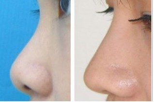 2023年海南哪家整形醫(yī)院口碑好？填充淚溝效果受網(wǎng)友推薦的醫(yī)院有哪些？