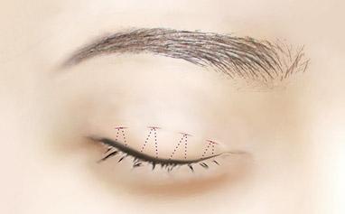 2023年武漢專(zhuān)業(yè)祛川字紋醫(yī)院排行榜出爐，TOP10強(qiáng)名單公布！