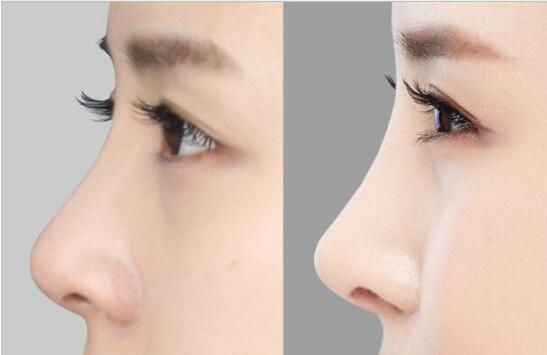 西安哪家醫(yī)院的手術(shù)祛除眉間紋效果比較好？2023西安一流美容醫(yī)院推薦top10！