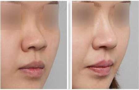 2023湖南口碑榜TOP10湖南隆鼻整形修復(fù)美容醫(yī)院名單