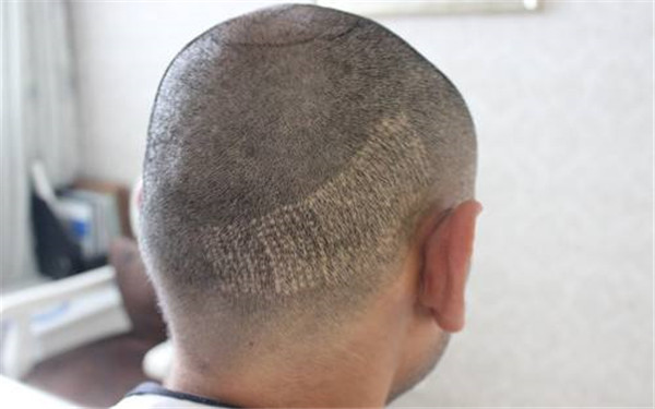 山東納米光斑整形醫(yī)院排名提前贊！推薦2023年山東納米光斑整形醫(yī)院前10位實(shí)力認(rèn)可！