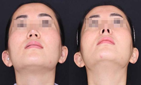 合肥自己的脂肪填充下巴整形醫(yī)院排名前三、前五+費(fèi)用全新一覽!