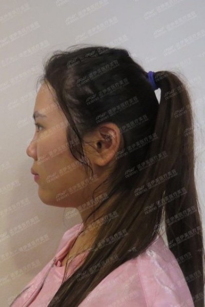 呼和浩特諾伊美劉星赫醫(yī)師鼻部多項手術(shù)案例反饋