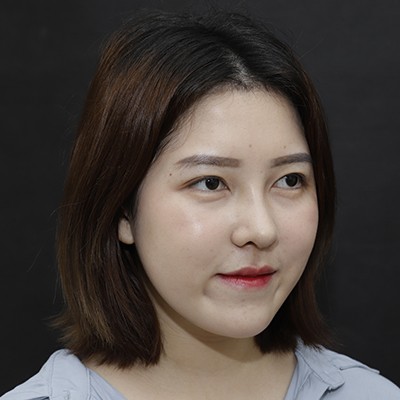 廣州美恩半肋鼻手術(shù)恢復(fù)效果反饋，主任親自操刀的效果就是贊！