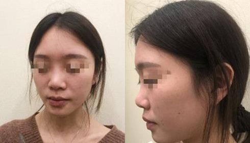 首都醫(yī)科大學(xué)附屬北京友誼醫(yī)院醫(yī)學(xué)美容中心耳軟骨隆鼻案例術(shù)前效果