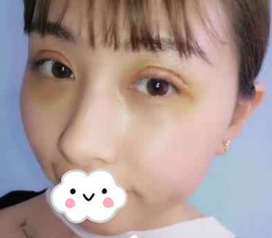 武漢亞太整形雙眼皮案例術(shù)后三天效果
