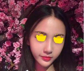 深圳鵬愛做隆鼻手術(shù)一個月效果