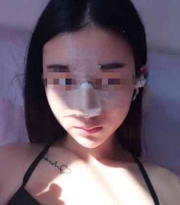 石家莊諾萬整形姚華榮硅膠隆鼻案例分享術(shù)后兩天效果 石家莊諾萬整形姚華榮硅膠隆鼻案例分享術(shù)后兩天效果