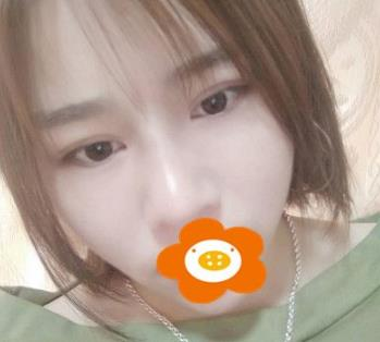 據(jù)說杭州薇琳隆鼻后效果很自然，有案例嗎