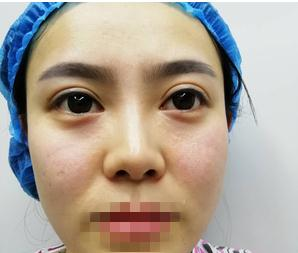 親身經(jīng)驗(yàn)，重慶星范整形的超體隆鼻真的很自然