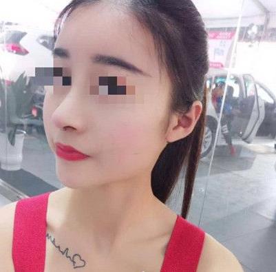 石家莊諾萬整形姚華榮硅膠隆鼻案例分享術(shù)前效果后三個月效果 石家莊諾萬整形姚華榮硅膠隆鼻案例分享術(shù)前效果后三個月效果