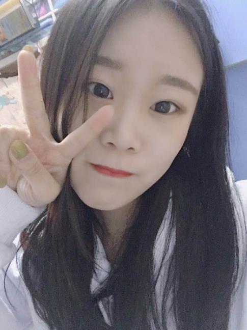 石家莊諾萬(wàn)整形肋軟骨隆鼻案例術(shù)后一個(gè)月效果