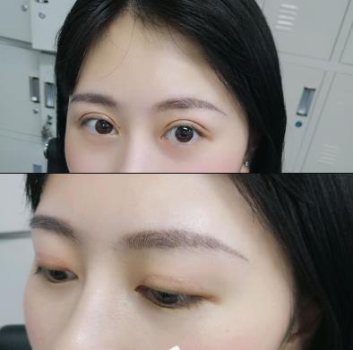 武漢亞太整形雙眼皮案例術(shù)后40天效果