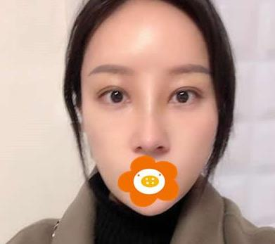 萬(wàn)萬(wàn)沒想到在鄭州禾麗做的肋軟骨隆鼻效果居然是這樣的